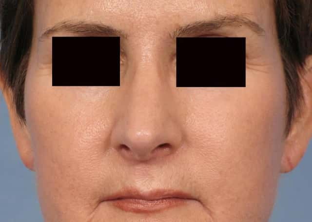 Rhinoplasty (Nose Reshaping) Before & After Case 78 after