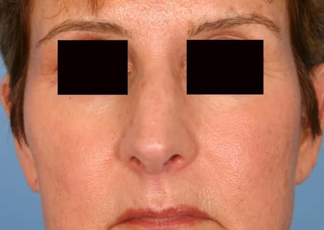 Rhinoplasty (Nose Reshaping) Before & After Case 78 before