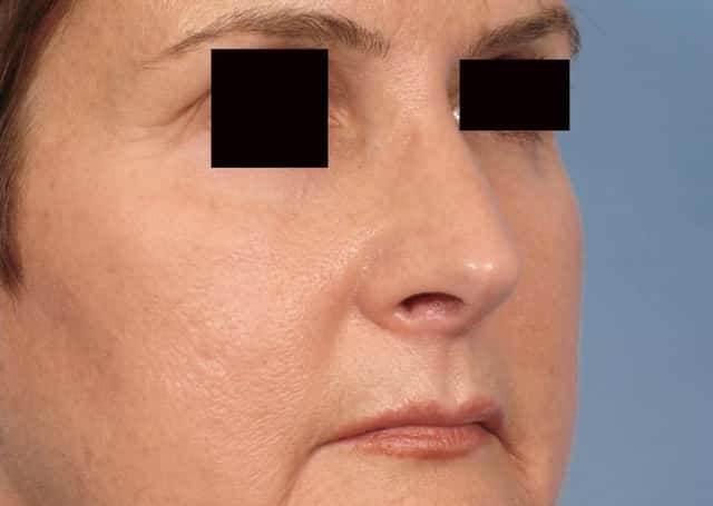 Rhinoplasty (Nose Reshaping) Before & After Case 78 after