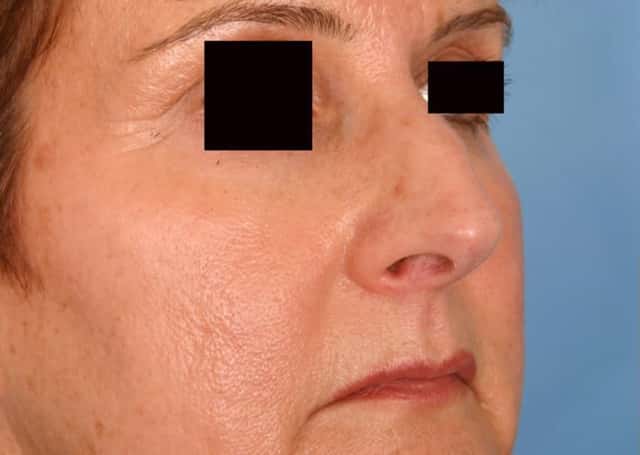 Rhinoplasty (Nose Reshaping) Before & After Case 78 before