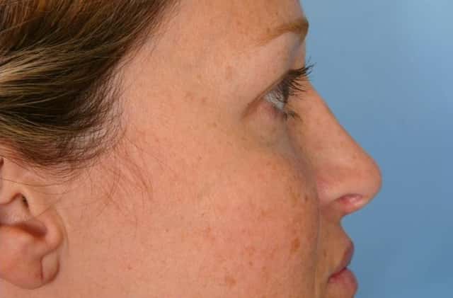 Rhinoplasty (Nose Reshaping) Before & After Case 79 after