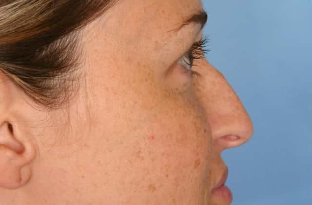 Rhinoplasty (Nose Reshaping) Before & After Case 79 before