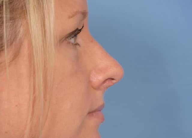 Rhinoplasty (Nose Reshaping) Before & After Case 87 after