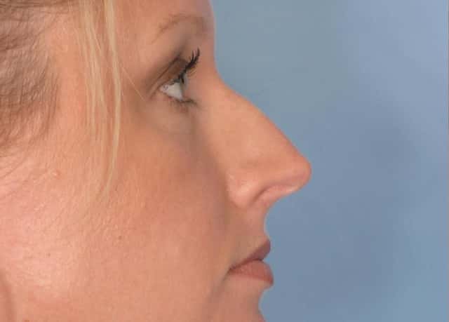 Rhinoplasty (Nose Reshaping) Before & After Case 87 before