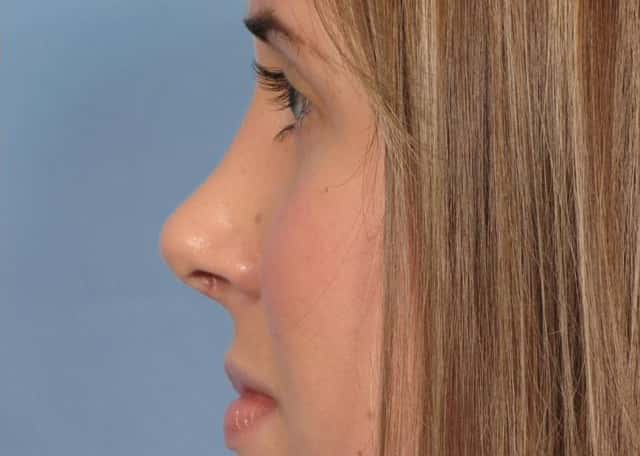 Rhinoplasty (Nose Reshaping) Before & After Case 91 after