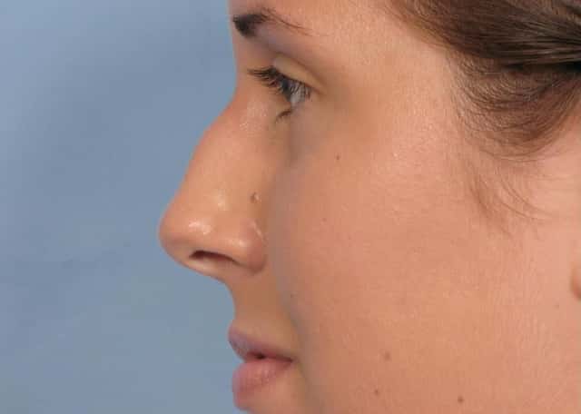 Rhinoplasty (Nose Reshaping) Before & After Case 91 before