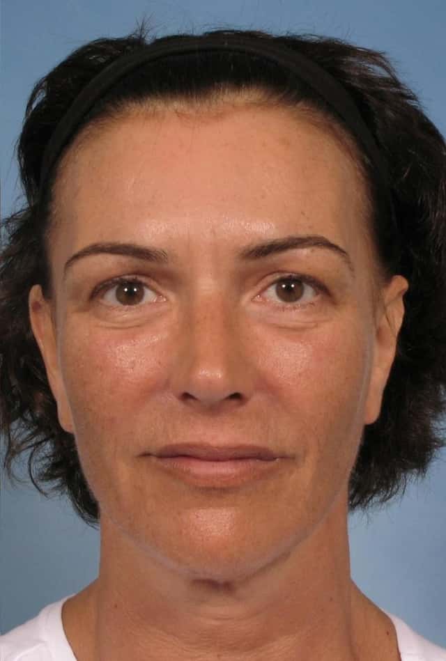 Sculptra® Before & After Case 126 after