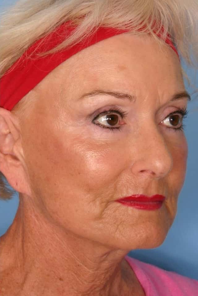 Sculptra® Before & After Case 64 after