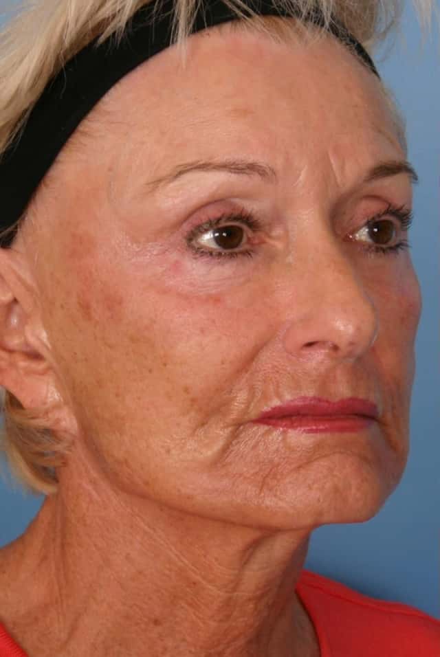 Sculptra® Before & After Case 64 before