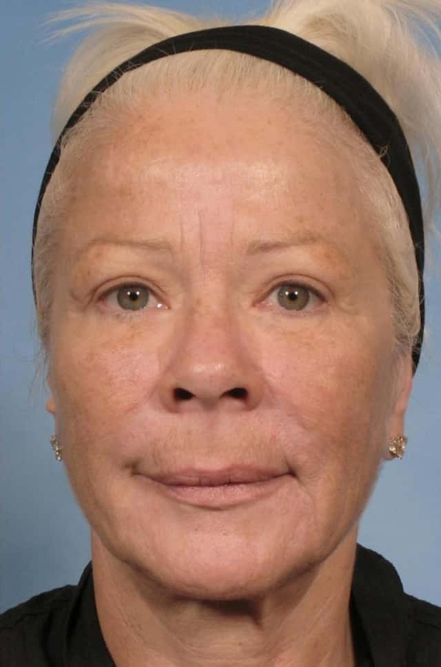 Sculptra® Before & After Case 84 after