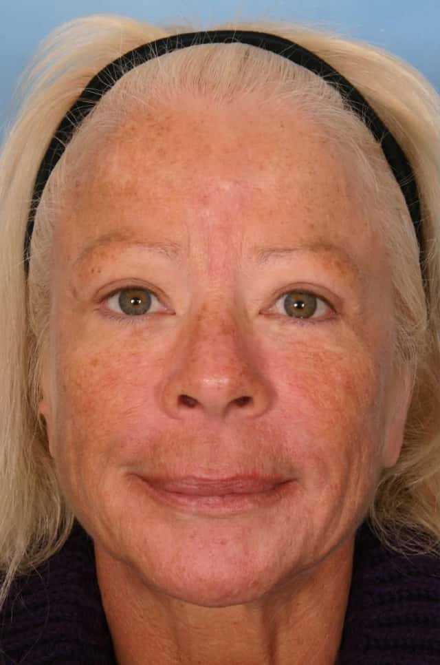 Sculptra® Before & After Case 84 before