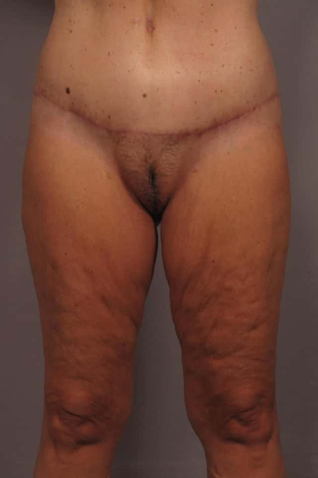 Thigh Lift Before and After, Front View