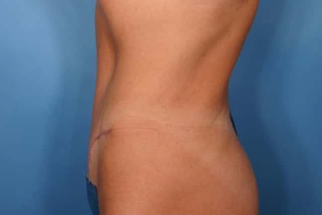Tummy Tuck Before & After Case 116 after