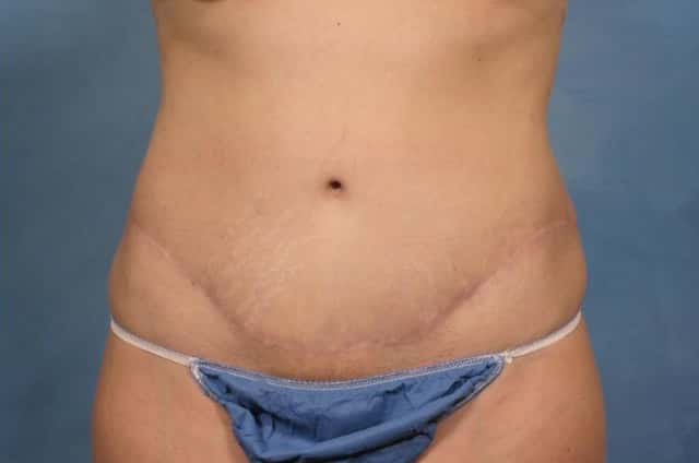 Tummy Tuck Before & After Case 130 after