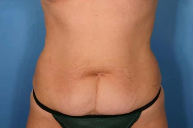 Tummy Tuck Before & After Case 130 before