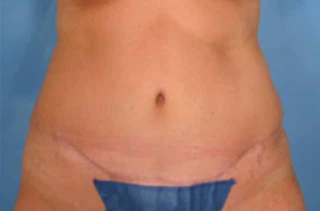 Tummy Tuck Before & After Case 15 after