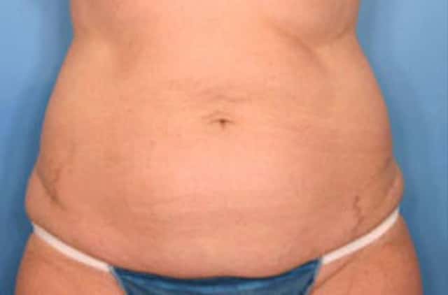 Tummy Tuck Before & After Case 15 before