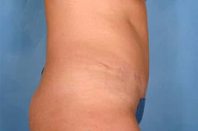 Tummy Tuck Before & After Case 15 after