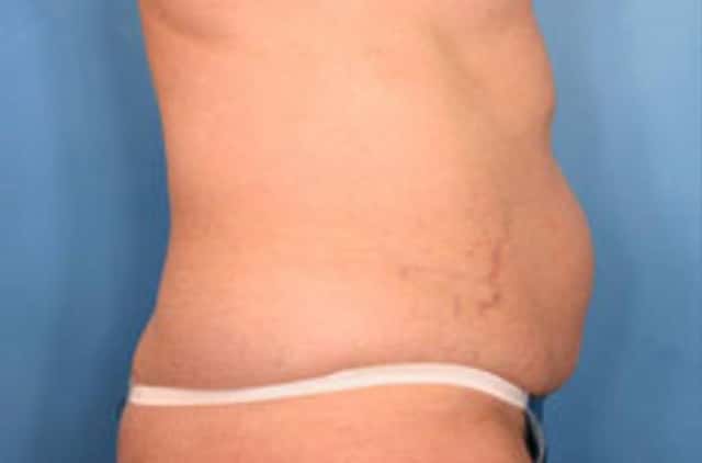 Tummy Tuck Before & After Case 15 before