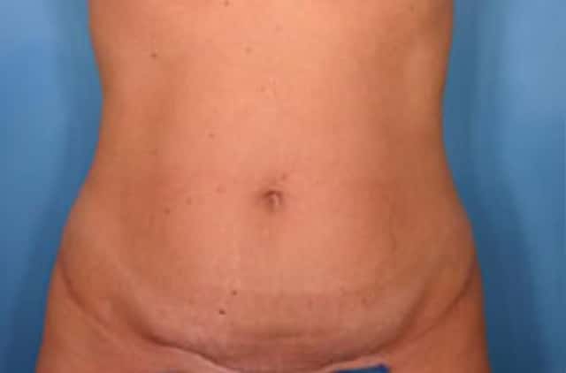 Tummy Tuck Before & After Case 16 before