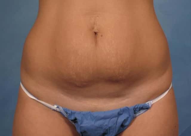 Tummy Tuck Before & After Case 170 before