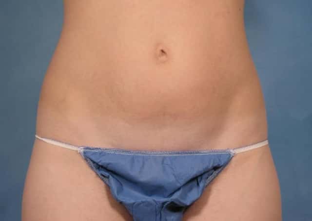 Tummy Tuck Before & After Case 172 before