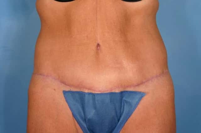Tummy Tuck Before & After Case 21 after