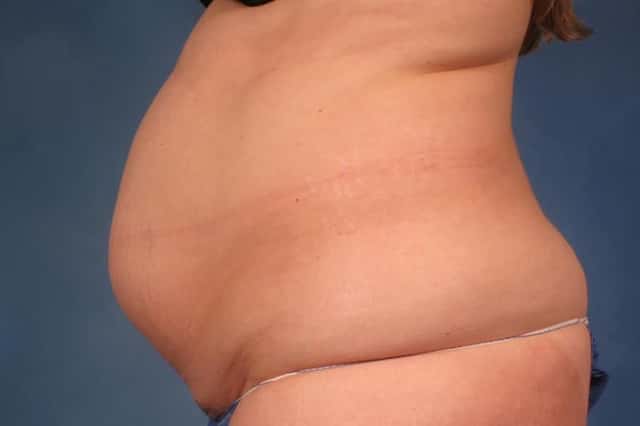 Tummy Tuck Before & After Case 234 before