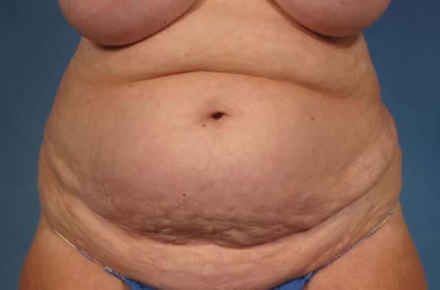 Tummy Tuck Before & After Case 245 before