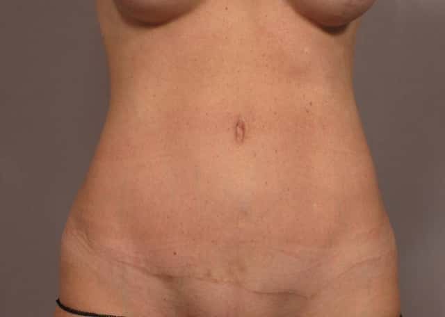 Tummy Tuck Before & After Case 326 after
