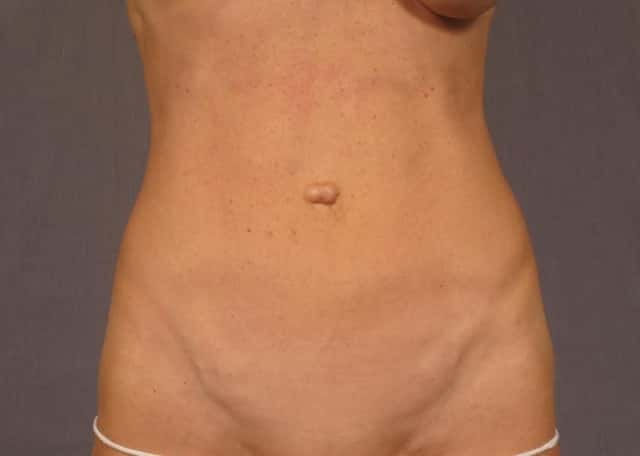 Tummy Tuck Before & After Case 326 before