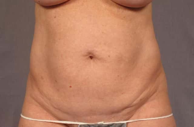Tummy Tuck in a 68 year Old Naples, Florida Woman before