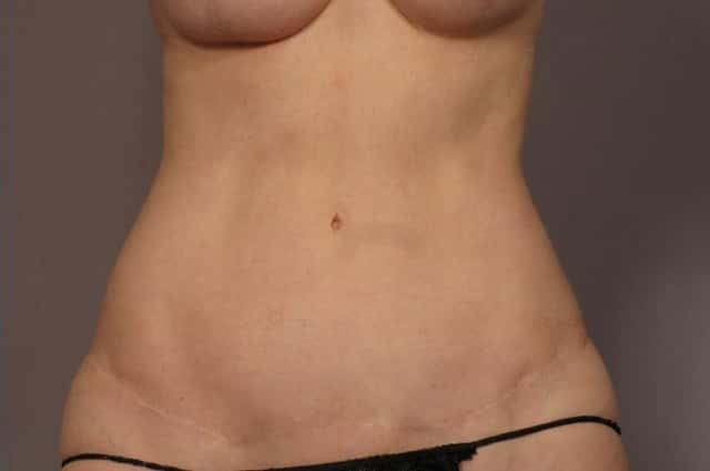 Tummy Tuck (Abdominoplasty) Before and 3 years after, Front View