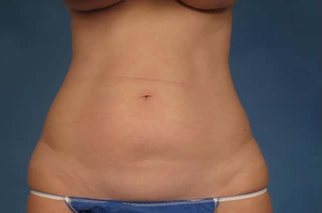 Tummy Tuck (Abdominoplasty) Before and 3 years after, Front View