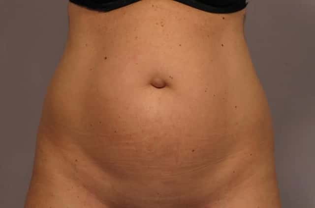 Frontal view, Tummy Tuck with Belly Button Hernia repair, pre-op