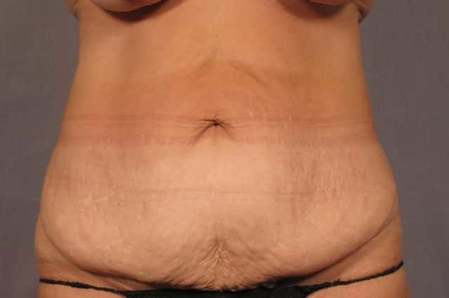 Before and After Photo of Tummy Tuck with Liposuction in a 50 year old Naples, Florida woman by Dr. Kent V. Hasen