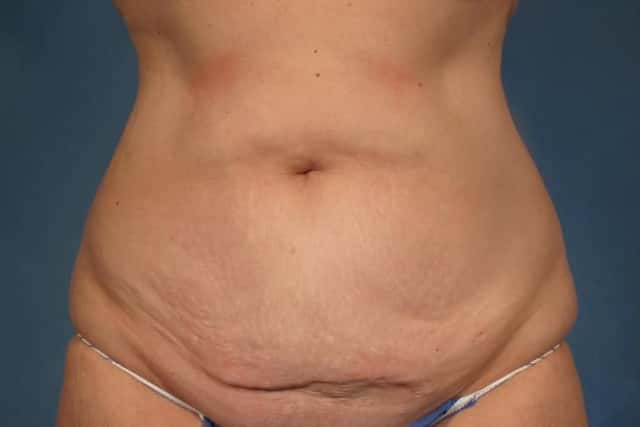 Before adn After Frontal Photo of Tummy Tuck by Dr Hasen