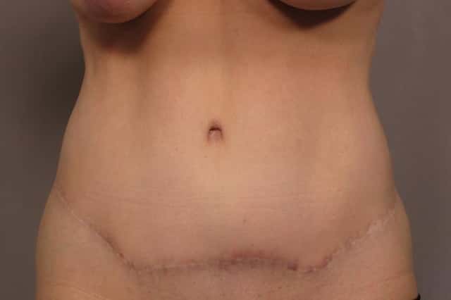 Before and 1 year After Photo of Tummy tuck by Dr. Kent Hasen in Naples, Florida