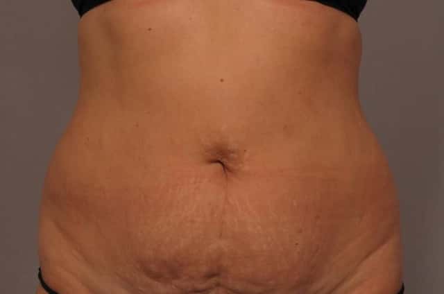 Tummy Tuck, Before and 3 Months After, Frontal View Photos by Dr. Kent V. Hasen