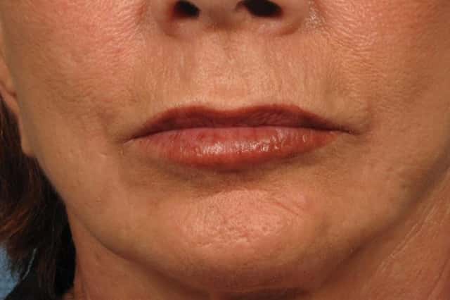 Upper Lip Lift Before & After Case 184 after