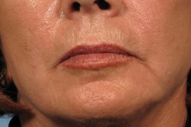 Upper Lip Lift Before & After Case 184 before