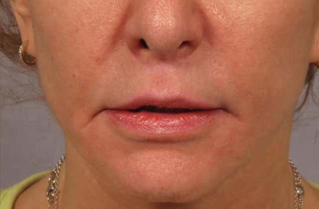 Front View Upper Lip Lift 6 months post-op