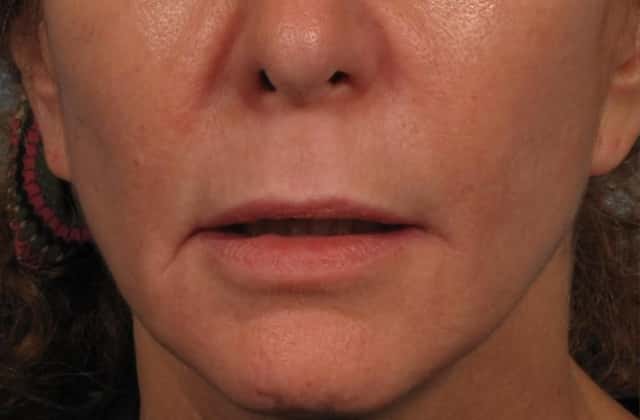 Front View Upper Lip Lift pre-operatively
