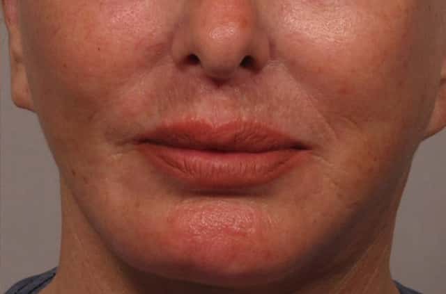 Frontal 6 month after photo of upper lip lift and fat grafting