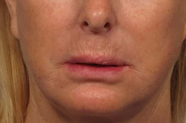 Frontal before photo of upper lip lift and fat grafting