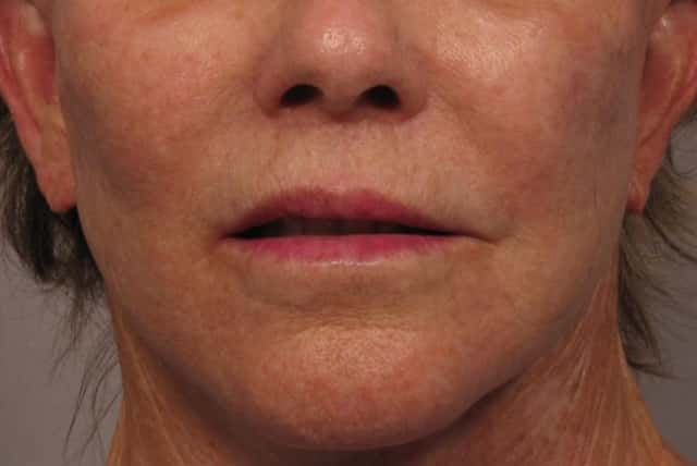 3 months after photo of Frontal view of Upper lip lift and fat grafting
