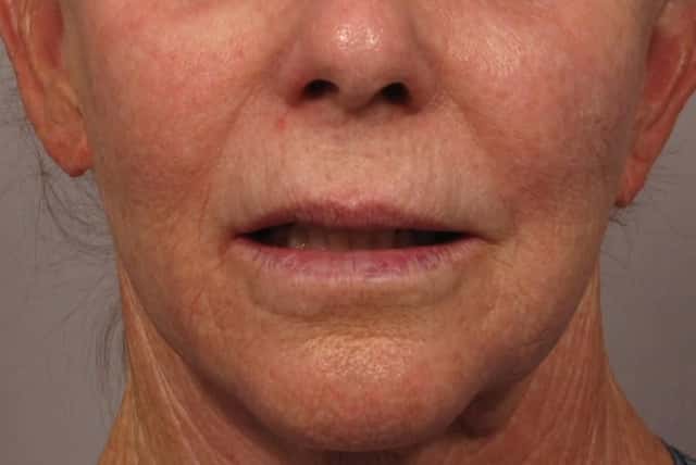 Before photo of Frontal view of Upper lip lift and fat grafting