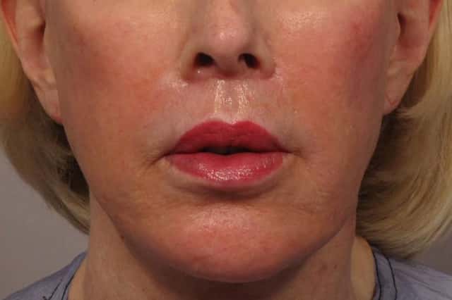 3 month after frontal photo after facelift, fat grafting and upper lip lift