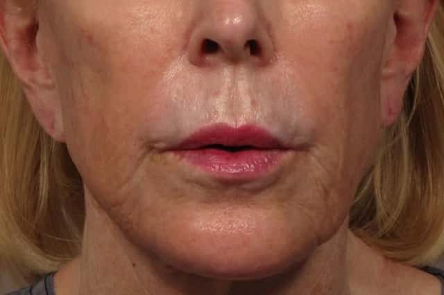 Before frontal photo of facelift, fat grafting and upper lip lift