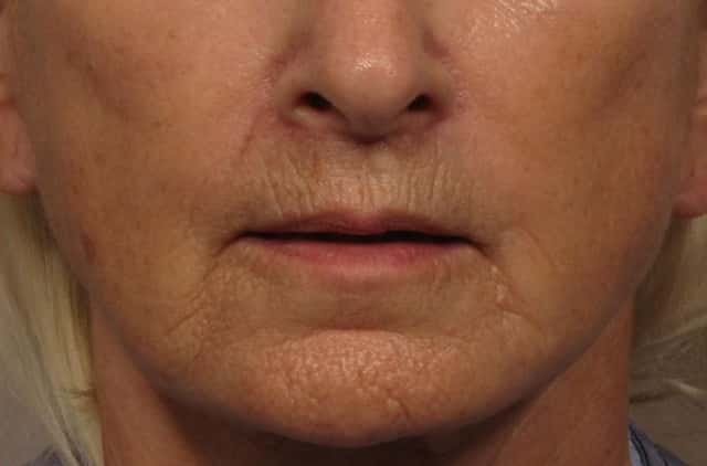 3 month After Frontal photo of facelift with upper lip lift and fat grafting